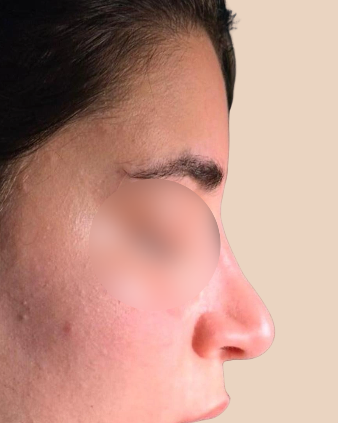 Revision Rhinoplasty before – nose surgery result Lebanon at The Face Institute Beirut