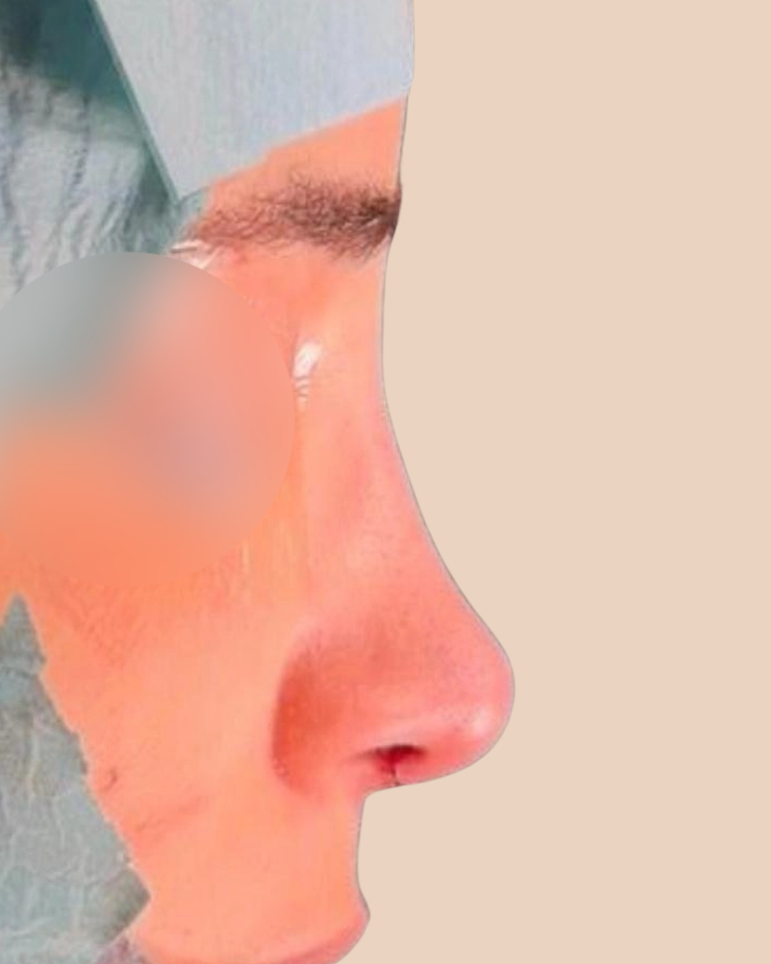 Revision Rhinoplasty after – nose surgery result Lebanon at The Face Institute Beirut