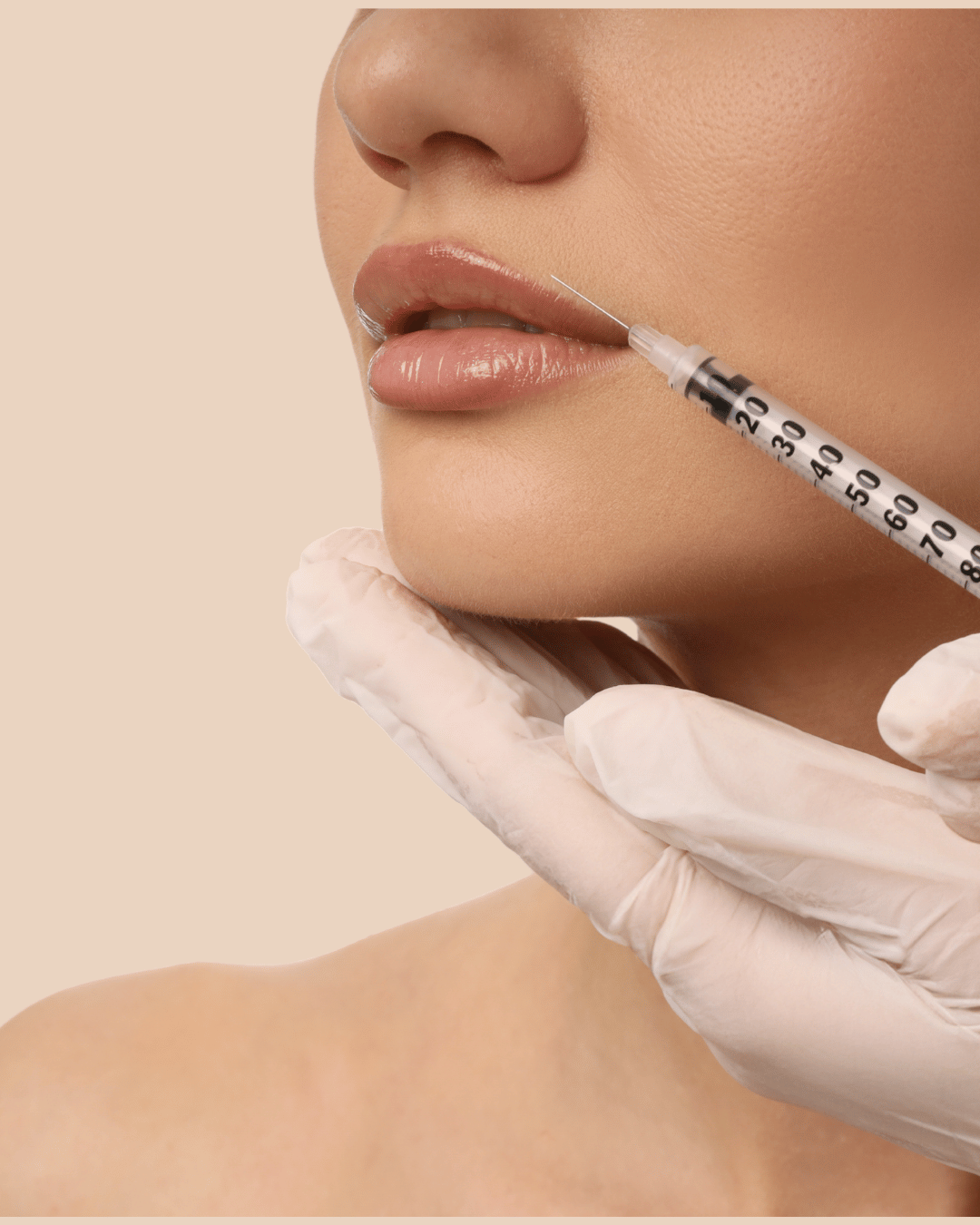 Lip Lift Surgery Lebanon – Subnasal Bullhorn Lip Lift Beirut at The Face Institute
