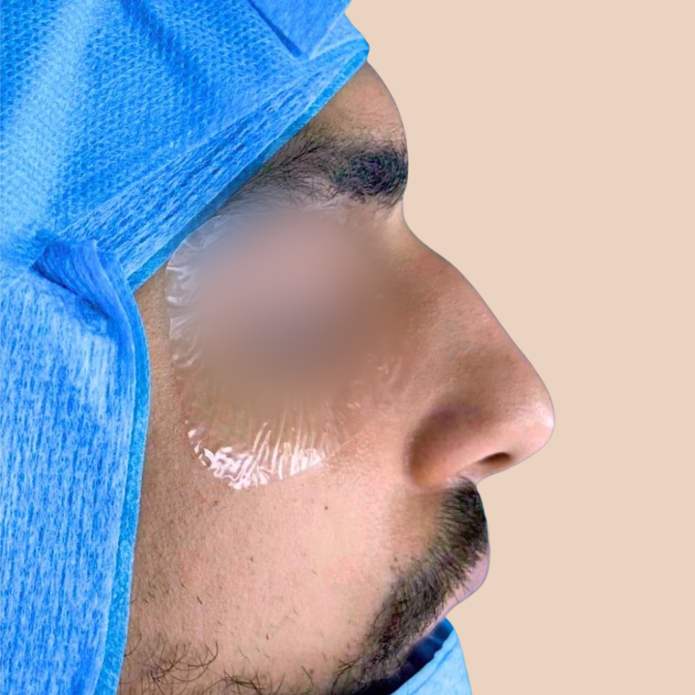 Primary Rhinoplasty before – nose job result Beirut Lebanon at The Face Institute
