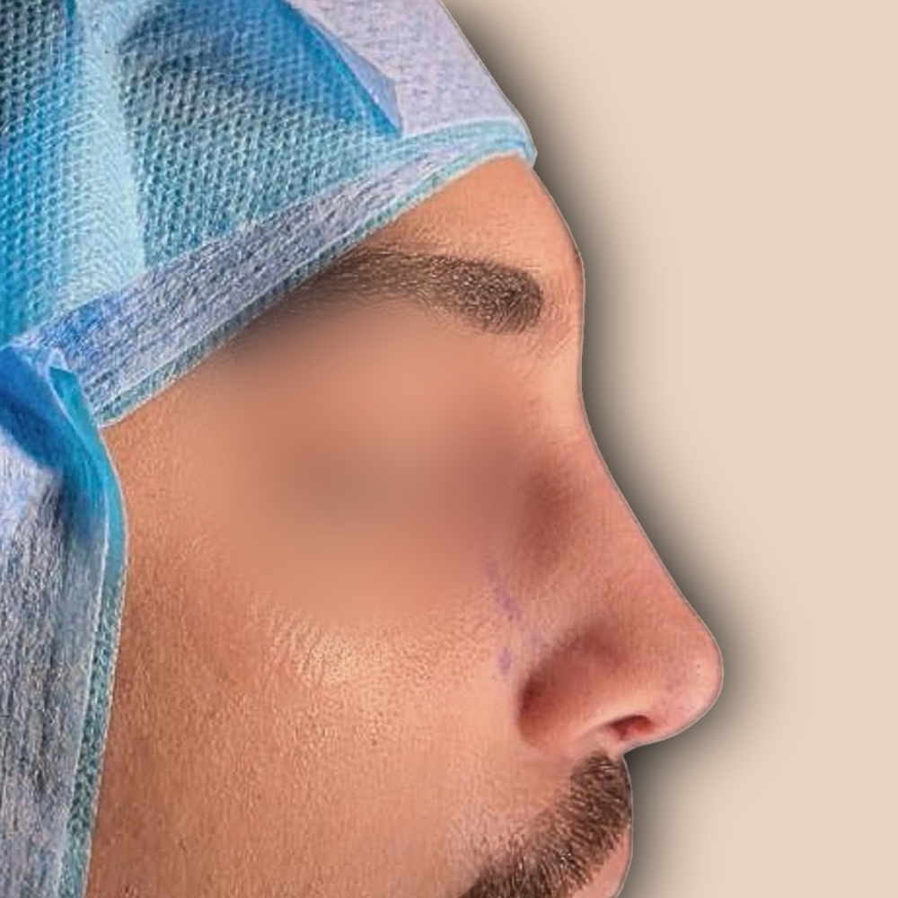 Primary Rhinoplasty after – nose job result Beirut Lebanon at The Face Institute